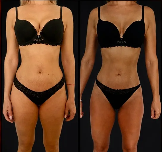 Comparativa frontal de Lorena antes y después de 173 días